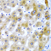 Immunohistochemistry of paraffin-embedded human liver damage using SECISBP2 antibody (22-448) at dilution of 1:200 (40x lens) .
