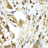 Immunohistochemistry of paraffin-embedded human liver cancer using TMOD4 antibody (22-474) at dilution of 1:100 (40x lens) .