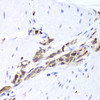 Immunohistochemistry of paraffin-embedded human gastric cancer using TPPP3 antibody (22-477) at dilution of 1:100 (40x lens) .