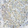 Immunohistochemistry of paraffin-embedded human lung cancer using TXN2 antibody (22-482) at dilution of 1:100 (40x lens) .