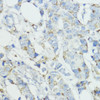 Immunohistochemistry of paraffin-embedded human mammary cancer using SOD3 antibody (22-606) at dilution of 1:100 (40x lens) .