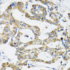 Immunohistochemistry of paraffin-embedded human colon carcinoma using SSBP1 antibody (22-609) at dilution of 1:100 (40x lens) .