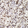 Immunohistochemistry of paraffin-embedded human kidney cancer using DDX21 antibody (22-646) at dilution of 1:100 (40x lens) .