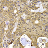 Immunohistochemistry of paraffin-embedded human oophoroma using NAA20 antibody (22-702) at dilution of 1:100 (40x lens) .
