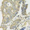 Immunohistochemistry of paraffin-embedded human colon carcinoma using IDH2 antibody (22-769) at dilution of 1:100 (40x lens) .