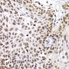 Immunohistochemistry of paraffin-embedded human well-differentiated squamous skin carcinoma using PHIP antibody (22-784) at dilution of 1:100 (40x lens) .