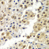 Immunohistochemistry of paraffin-embedded human liver cancer using SYNCRIP antibody (22-792) at dilution of 1:100 (40x lens) .