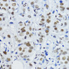 Immunohistochemistry of paraffin-embedded human mammary cancer using Acetyl-Histone H3-K27 antibody (22-811) at dilution of 1:200 (40x lens) .