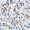Immunohistochemistry of paraffin-embedded human mammary cancer using Acetyl-Histone H3-K9 antibody (22-814) at dilution of 1:200 (40x lens) .