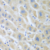 Immunohistochemistry of paraffin-embedded human liver cancer using BLVRB antibody (22-819) at dilution of 1:100 (40x lens) .