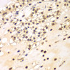 Immunohistochemistry of paraffin-embedded human kidney cancer using BCAS3 antibody (22-827) at dilution of 1:100 (40x lens) .