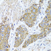 Immunohistochemistry of paraffin-embedded human prostate cancer using PEX14 antibody (22-871) at dilution of 1:100 (40x lens) .