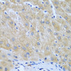 Immunohistochemistry of paraffin-embedded human liver cancer using FURIN antibody (22-945) at dilution of 1:100 (40x lens) .
