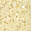 Immunohistochemistry of paraffin-embedded human brain cancer using SPAG16 antibody (22-974) at dilution of 1:100 (40x lens) .