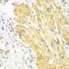 Immunohistochemistry of paraffin-embedded human gastric cancer using PTK6 antibody (22-985) at dilution of 1:100 (40x lens) .