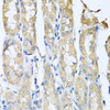 Immunohistochemistry of paraffin-embedded human gastric cancer using CCL3 antibody (23-032) at dilution of 1:100 (40x lens) .