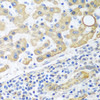 Immunohistochemistry of paraffin-embedded human liver cancer using GLUD1 antibody (23-064) at dilution of 1:100 (40x lens) .