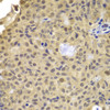 Immunohistochemistry of paraffin-embedded human well-differentiated squamous skin carcinoma using Cyclin A2 antibody (23-065) at dilution of 1:100 (40x lens) .
