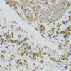 Immunohistochemistry of paraffin-embedded human lung cancer using IRF1 antibody (23-112) (40x lens) .