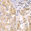 Immunohistochemistry of paraffin-embedded human liver cancer using SULT2B1 antibody (23-144) at dilution of 1:100 (40x lens) .