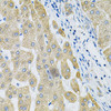 Immunohistochemistry of paraffin-embedded human liver cancer using ALG2 Antibody (23-221) at dilution of 1:100 (40x lens) .