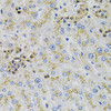 Immunohistochemistry of paraffin-embedded human liver damage using AARS antibody (23-235) (40x lens) .