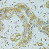 Immunohistochemistry of paraffin-embedded human breast cancer using MTCH1 antibody (23-375) at dilution of 1:100 (40x lens) .