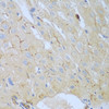 Immunohistochemistry of paraffin-embedded human liver cancer using CEACAM7 antibody (23-409) at dilution of 1:100 (40x lens) .