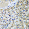 Immunohistochemistry of paraffin-embedded human liver cancer using XPC antibody (23-527) at dilution of 1:100 (40x lens) .