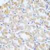 Immunohistochemistry of paraffin-embedded human stomach cancer using ANKRD52 antibody (23-543) at dilution of 1:100 (40x lens) .