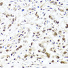Immunohistochemistry of paraffin-embedded human gastric cancer using HIRA antibody (23-599) at dilution of 1:100 (40x lens) .