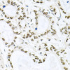 Immunohistochemistry of paraffin-embedded human gastric cancer using BCCIP antibody (23-675) at dilution of 1:100 (40x lens) .