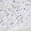 Immunohistochemistry of paraffin-embedded human lung cancer using CEMIP antibody (23-676) at dilution of 1:150 (40x lens) .