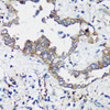 Immunohistochemistry of paraffin-embedded human lung cancer using ELP3 antibody (23-954) at dilution of 1:200 (40x lens) .