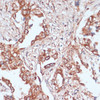 Immunohistochemistry of paraffin-embedded human lung cancer using ACAT1 antibody (19-597) at dilution of 1:100 (40x lens) .