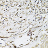 Immunohistochemistry of paraffin-embedded human prostate cancer using CD31 antibody (18-982) at dilution of 1:100 (40x lens) .