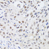 Immunohistochemistry of paraffin-embedded human lung cancer using CBX4 antibody (22-061) at dilution of 1:100 (40x lens) .