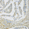 Immunohistochemistry of paraffin-embedded human colon carcinoma using CDKN2A / p16INK4a antibody (14-191) at dilution of 1:100 (20x lens) .