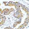 Immunohistochemistry of paraffin-embedded human colon carcinoma using GCG antibody (13-951) at dilution of 1:100 (40x lens) .