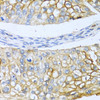 Immunohistochemistry of paraffin-embedded human prostate cancer using BMP4 antibody (13-980) at dilution of 1:100 (40x lens) .