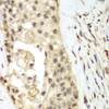 Immunohistochemistry of paraffin-embedded human lung cancer using FGFR1 antibody (15-021) at dilution of 1:100 (40x lens) .