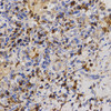 Immunohistochemistry of paraffin-embedded human lung cancer using Eif2ak2 antibody (15-086) at dilution of 1:200 (40x lens) .