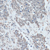 Immunohistochemistry of paraffin-embedded human lung cancer using ZNF707 antibody (15-174) at dilution of 1:100 (40x lens) .