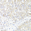 Immunohistochemistry of paraffin-embedded human liver cancer using ATP1B1 antibody (15-288) at dilution of 1:100 (40x lens) .