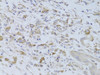 Immunohistochemistry of paraffin-embedded human breast cancer using IGF2 Antibody (15-317) at dilution of 1:100 (40x lens) .