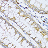 Immunohistochemistry of paraffin-embedded human colon carcinoma using ALOX12 antibody (15-675) at dilution of 1:100 (40x lens) .