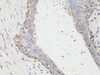 Immunohistochemistry of paraffin-embedded human breast cancer using LC3A / LC3B antibody (16-124) at dilution of 1:100 (40x lens) .