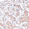 Immunohistochemistry of paraffin-embedded human breast cancer using PRMT7 antibody (16-877) at dilution of 1:200 (40x lens) .