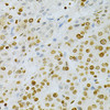 Immunohistochemistry of paraffin-embedded human liver cancer using DKC1 Antibody (18-354) at dilution of 1:200 (40x lens) .