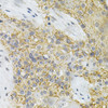 Immunohistochemistry of paraffin-embedded human esophageal cancer using PPP2R4 Antibody (18-379) at dilution of 1:200 (40x lens) .